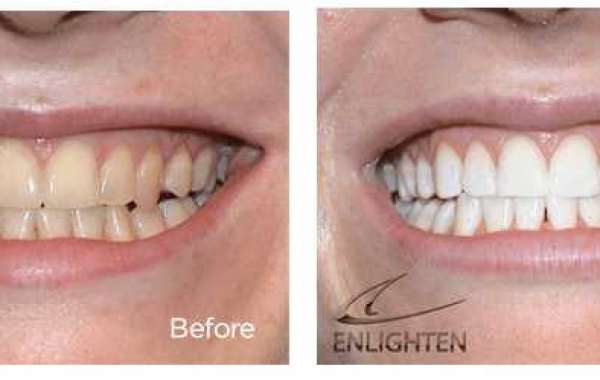 Teeth Whitening Which Patch License Pc .zip